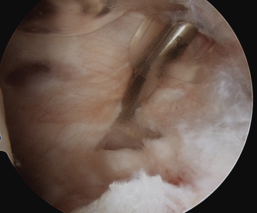 Posterior Shoulder Capsulotomy to decompress cyst